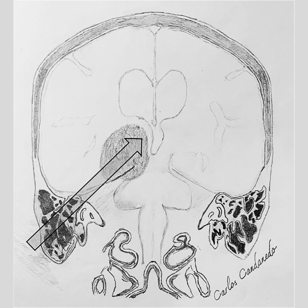 The infratranstentorial subtemporal approach (ITSTA): a valuable skull ...